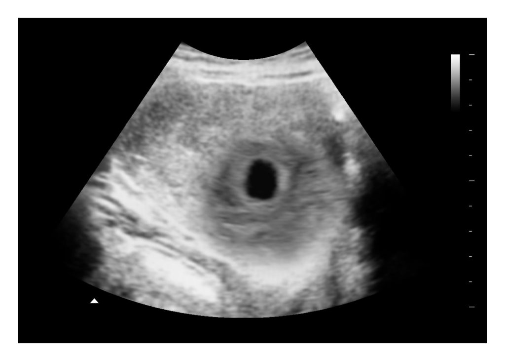 Miscarriage ultrasound image