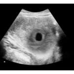 Early Miscarriage 2d Ultrasound - Digital PDF