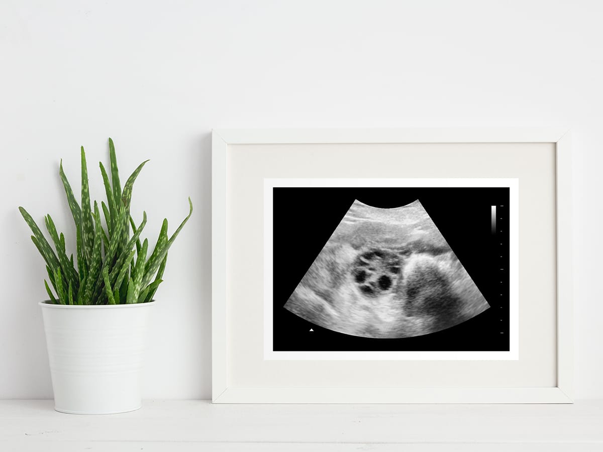 Polycystic ovary ultrasound in a frame