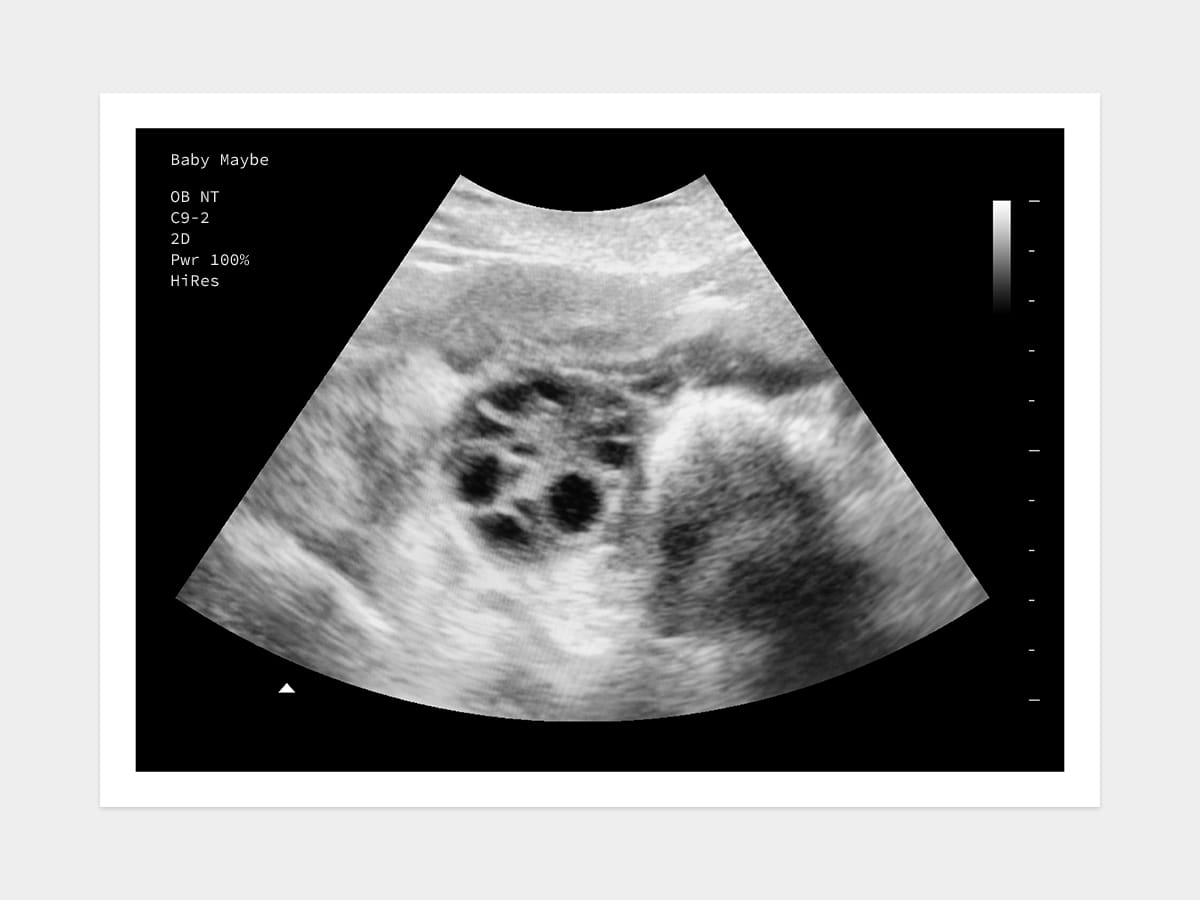 Polycystic ovary ultrasound image