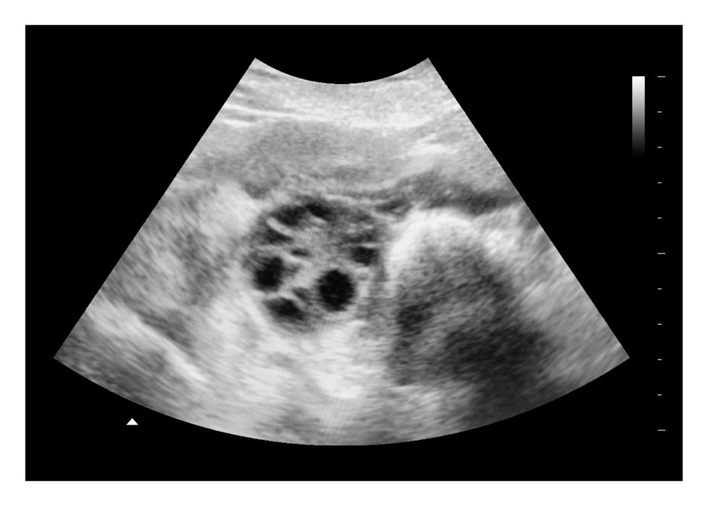 Polycystic ovary ultrasound image