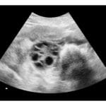 Polycystic Ovary 2d Ultrasound - Digital PDF
