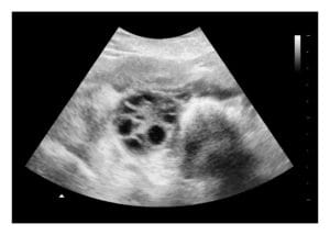 Polycystic ovary ultrasound image