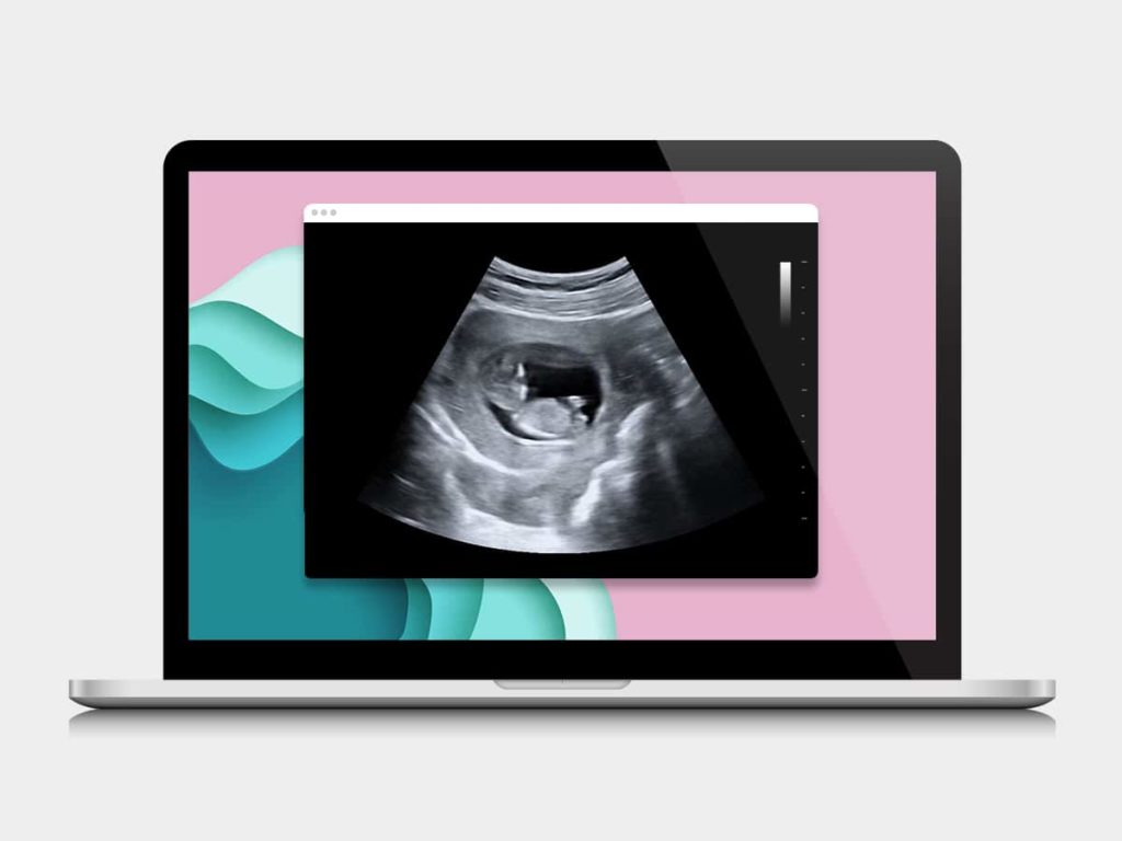 A fake ultrasound video on a laptop