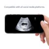 7 weeks ultrasound video social media compatible