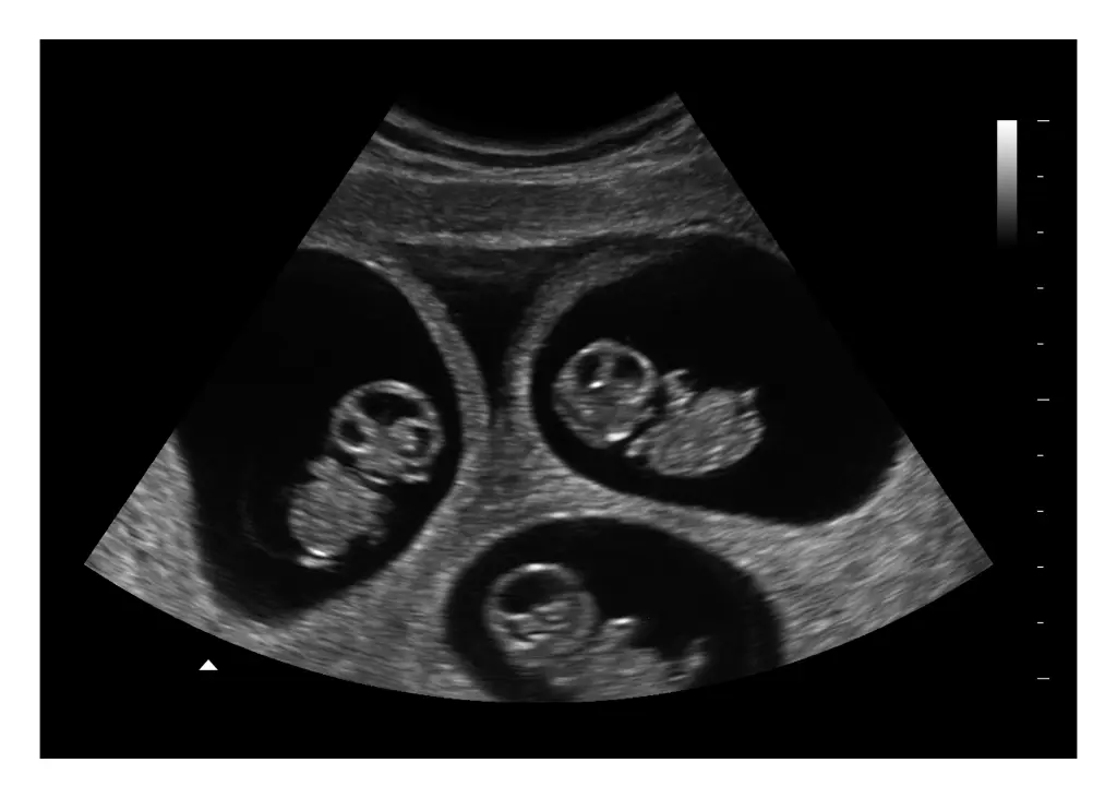 10 Weeks Triplets Fake Ultrasound Image