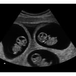 10-Weeks Triplets 2d Ultrasound - Digital PDF