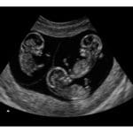 10 Weeks Triplets Fake Ultrasound Image