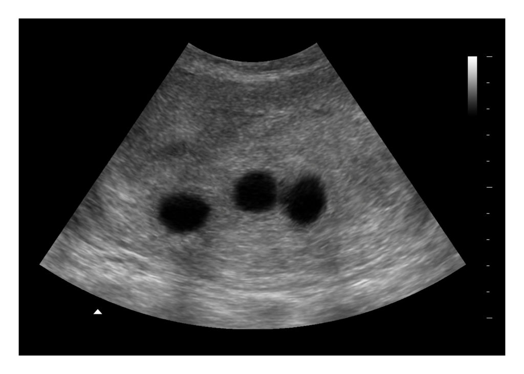 4 Weeks Triplets Fake Ultrasound Image