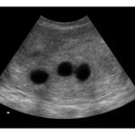 4-Weeks Triplets 2d Ultrasound - Digital PDF