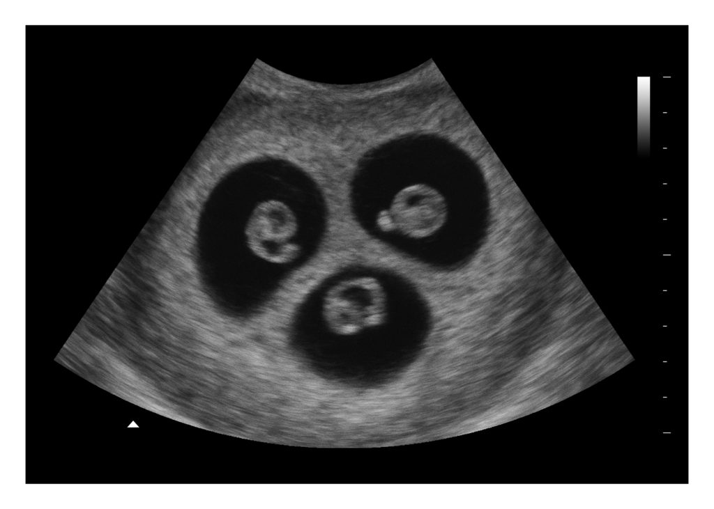6 Weeks Triplets Fake Ultrasound Image
