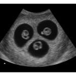 6 Weeks Triplets Fake Ultrasound Image