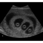 6 Weeks Triplets Fake Ultrasound Image