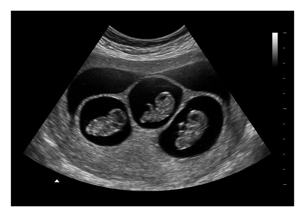 8 Weeks Triplets Fake Ultrasound Image