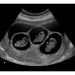 8 Weeks Triplets Fake Ultrasound Image