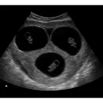8 Weeks Triplets Fake Ultrasound Image